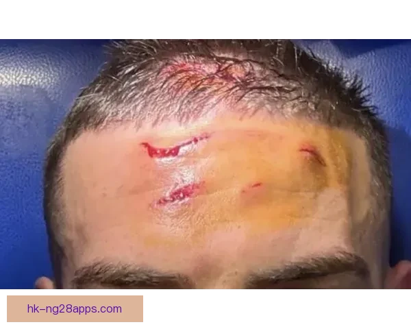 克尔斯托维奇晒伤口照回应被本塞拜尼踢伤